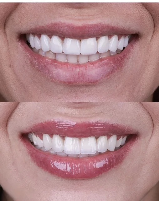 Full transformation: before treatment, the teeth exhibited significant wear, loss of vertical dimension, and yellowing; after treatment, a full-arch rehabilitation utilizing custom ceramic restorations completely restored proper function, symmetry, and vibrant aesthetics.